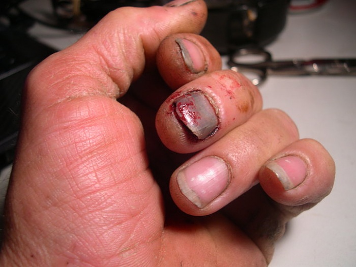 If you smash your finger.......-31354_1316443994343_5049493_n.jpg